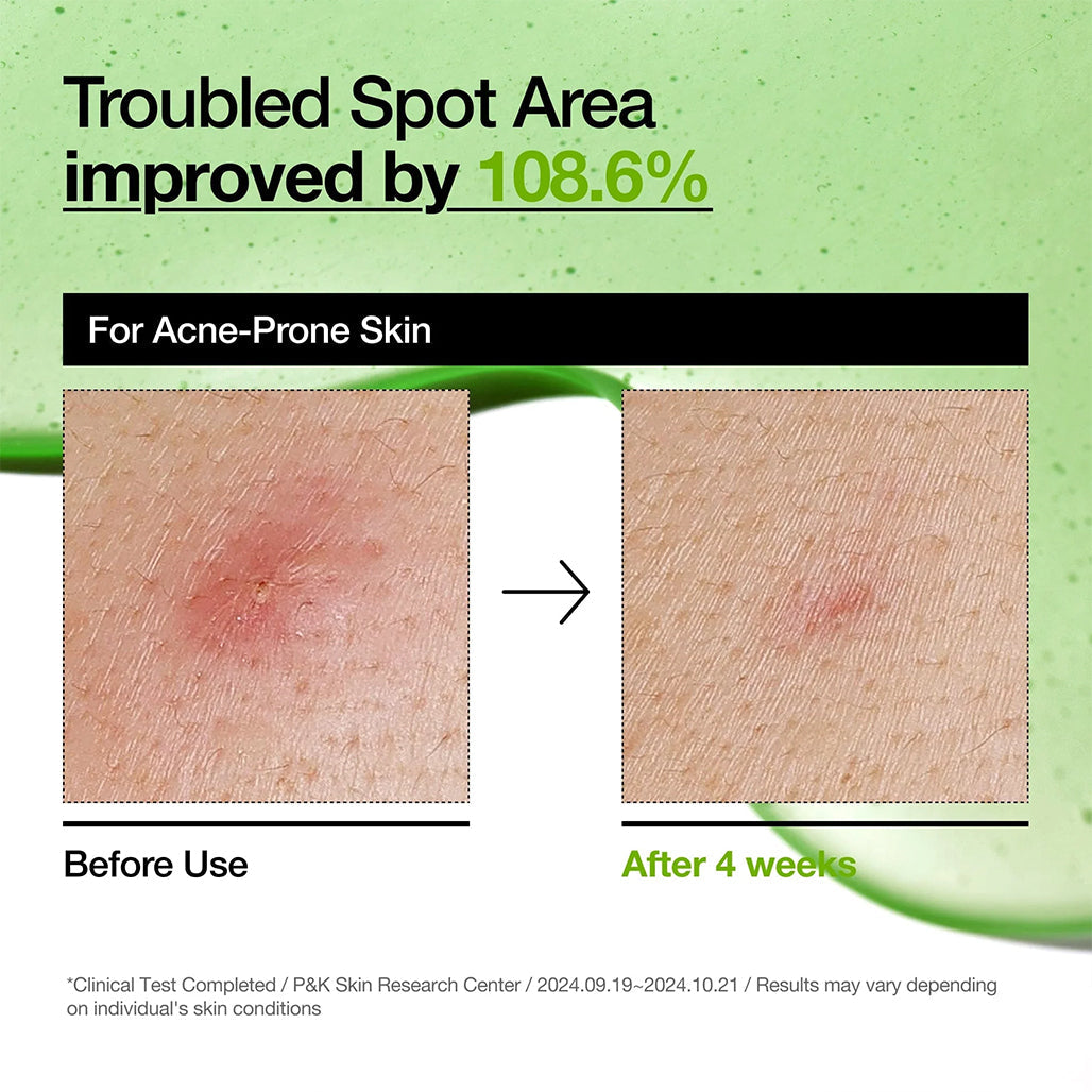 Anua Azelaic Acid 10+ - Hyaluron Redness Soothing Serum